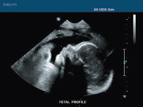 Ultrasound Ultrasound